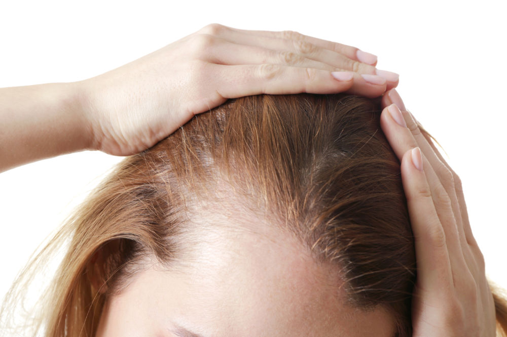 Receding Hairline: Stages, Causes, Prevention and Treatment Options 3 Receding Hairline: Stages, Causes, Prevention and Treatment Options 3