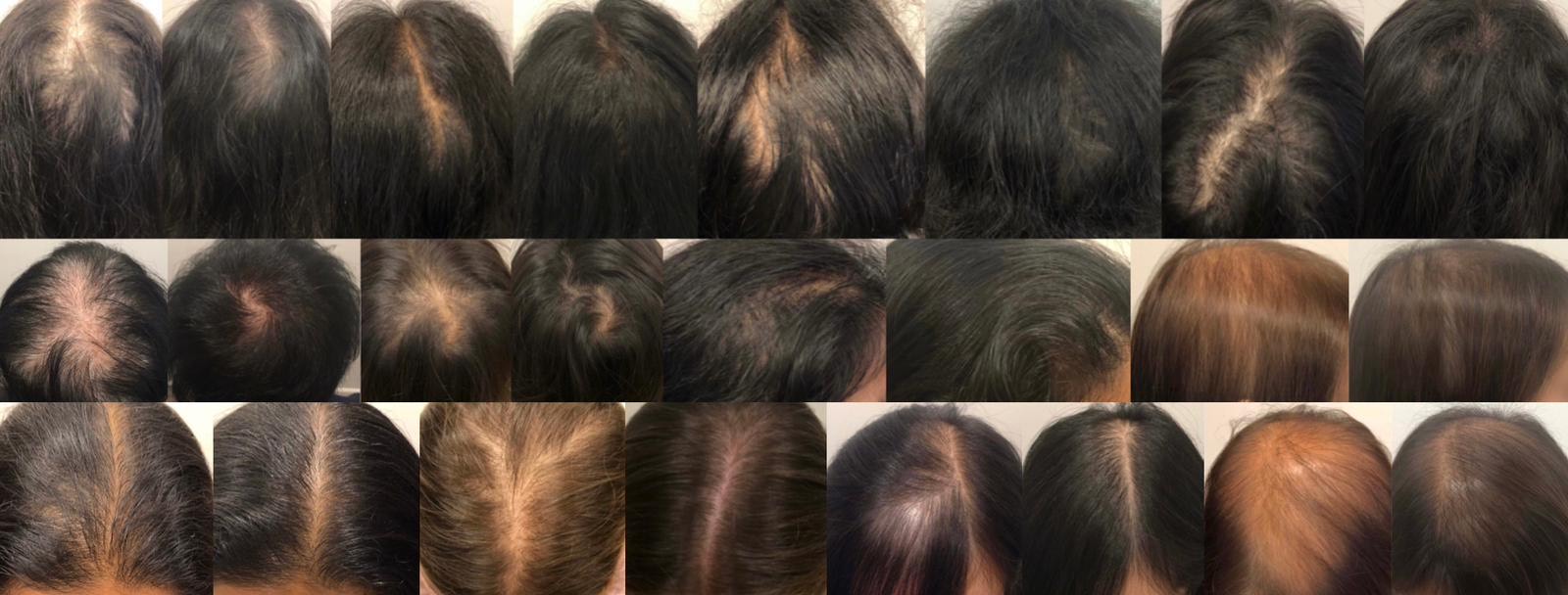 Exosomes for Hair Loss: A Spotlight on Exosomes Brands 2