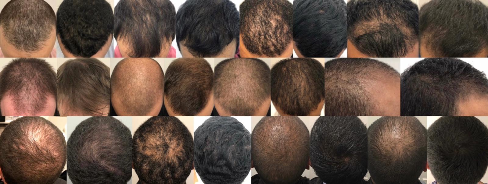 Exosomes for Hair Loss: A Spotlight on Exosomes Brands 1
