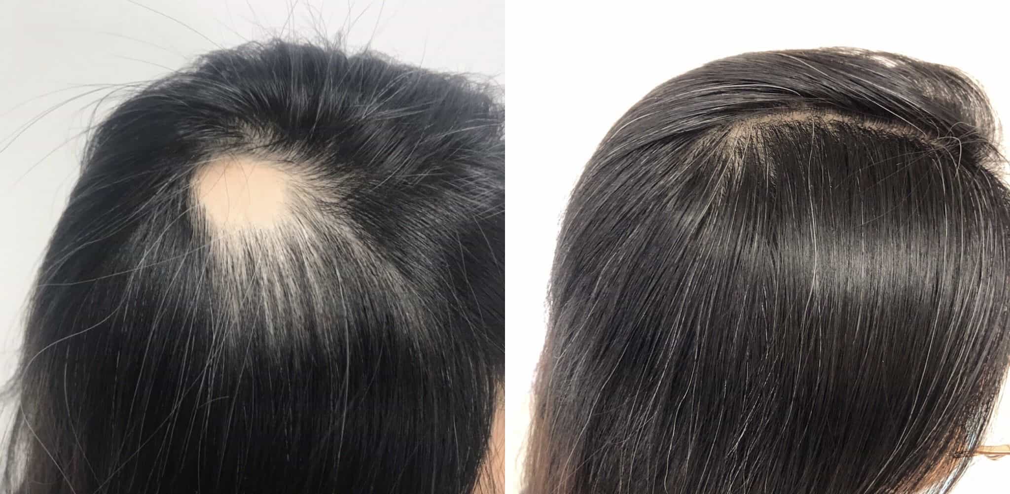 PRP before and after – See the results for yourself 6