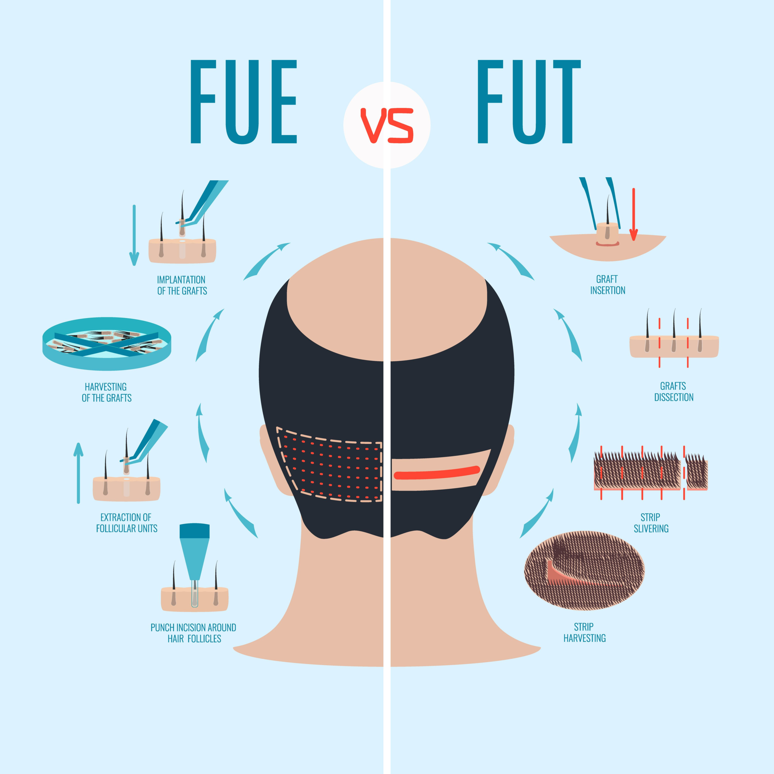 What Is A Hair Transplant? The Ultimate Guide To Hair Transplants in Australia 1 What Is A Hair Transplant? The Ultimate Guide To Hair Transplants in Australia 1